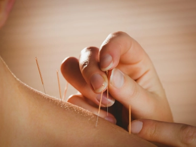 Acupuncture 400x300 1